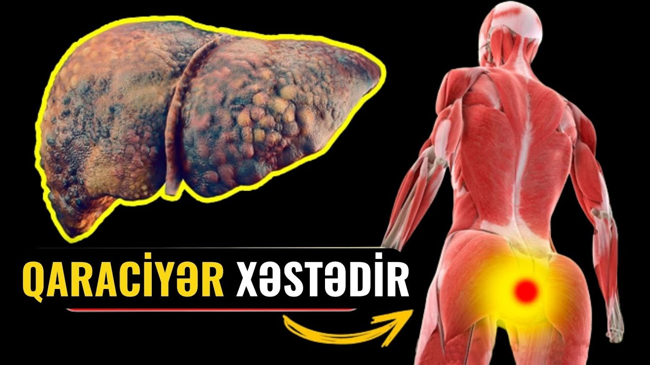 Qaraciyərin öldüyünü göstərən 14 əlamət! (VİDEO)