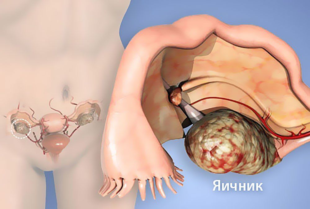 Yumurtalıq xərçənginin 9 qeyri – adi əlaməti