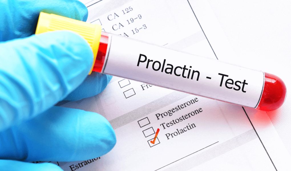 Qadınlarda prolaktin yüksəlməsinin – 5 SƏBƏBİ